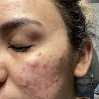 Reign Beauty Studio - January before I started a skin care regiment - Skin Care Near Me - Norco, California Reign Beauty Studio - January before I started a skin care regiment - Skin Care Near Me - Norco, California