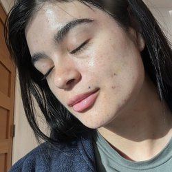 New Skin by Lynn - Chemical peeling