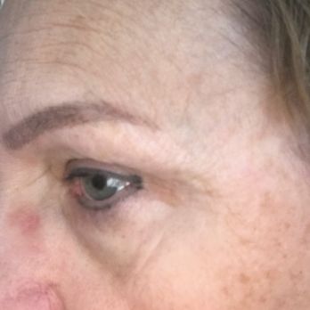 Vero Derm - left side, placed below wrinkles not across them like on the right side which is tattooed to high - Medical Spas Near Me - Tampa, Florida Vero Derm - left side, placed below wrinkles not across them like on the right side which is tattooed to high - Medical Spas Near Me - Tampa, Florida