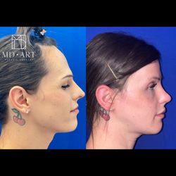 Artur Fahradyan, MD - MD Art Plastic Surgery - Facial Feminization
