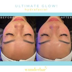 Korman Plastic Surgery - Standard Glow Hydrafacial