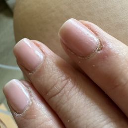 Cut the skin off my finger now gettint infected Cut the skin off my finger now gettint infected