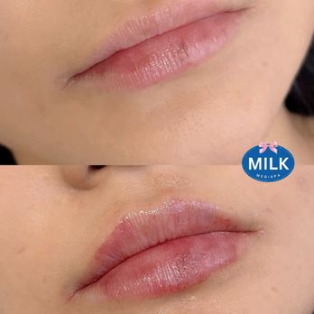 MILK MEDISPA - This client wanted a natural enhancement, so we focused on subtle lift and definition to complement her features - Medical Spas Near Me - Los Angeles, California
