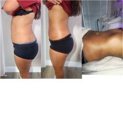 Brazilian Body Sculpting - Slimming Belly treatments 
Slimming Belly treatments