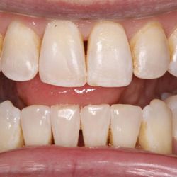 Boulder Valley Dental Center - We achieved this beautiful result with clear aligner treatment in less than a year!
