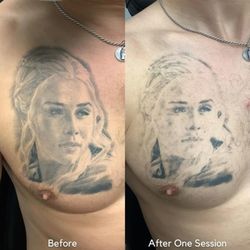Removery Tattoo Removal & Fading