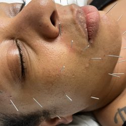 The Healing Sp-ce: Acupuncture & Traditional Asian Medicine - Cosmetic facial acupcunture.