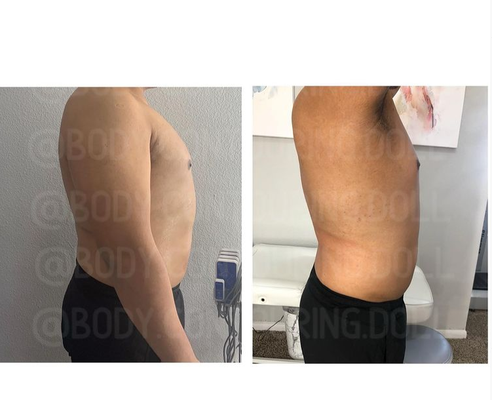 Body Sculpting/Contouring - Non surgical solutions for your pesky body problems! Call or Text and book with us today!