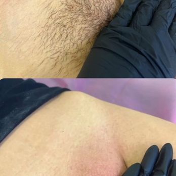 Naked Moone - Before and After of Brazilian Wax. - Estheticians Near Me - Union City, New Jersey Naked Moone - Before and After of Brazilian Wax. - Estheticians Near Me - Union City, New Jersey