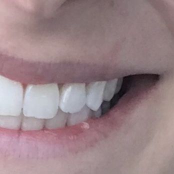 Smiling Bright - Teeth Whitening Near Me - Chicago, Illinois Smiling Bright - Teeth Whitening Near Me - Chicago, Illinois