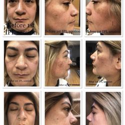 Empire MedSpa - IPL therapy uses many wavelengths to fix unwanted skin pigment conditions or vein changes, acne or rejuvenation.