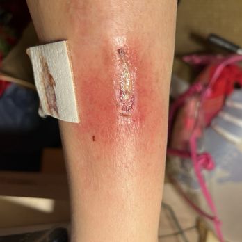 Extra Space Storage - Infected wound 2 weeks after running into metal rod protruding from wall on a blind corner at Extra Space storage - Self Storage Near Me - Los Angeles, California Extra Space Storage - Infected wound 2 weeks after running into metal rod protruding from wall on a blind corner at Extra Space storage - Self Storage Near Me - Los Angeles, California