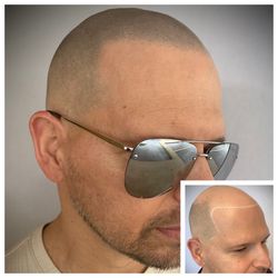 Precision Scalp Micropigmentation - Full head, SMP