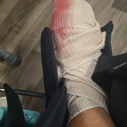 Sentara Northern Virginia Medical Center - My recent photo of my foot after EMT threw the wheelcahir into a chair and it hit my surgical area