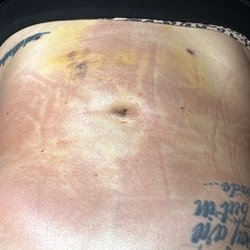 Talbott Plastic Surgery Center - 5 days after