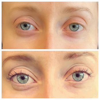 Glow Skin Care - The difference before and after! - Skin Care Near Me - Santa Rosa, California Glow Skin Care - The difference before and after! - Skin Care Near Me - Santa Rosa, California