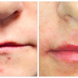 PRANA Skincare Clinic - Fotona Laser LipLase Treatment- rebuilding your lips natural collagen with laser therap.