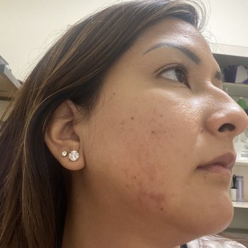 PS Skincare - After: No Inflammation, No more Pain and redness has gone down - Skin Care Near Me - La Jolla, California PS Skincare - After: No Inflammation, No more Pain and redness has gone down - Skin Care Near Me - La Jolla, California