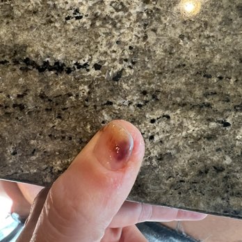 True Touch Nails Spa - Allergic reaction to cheap acrylic - Nail Salons Near Me - Corona, California