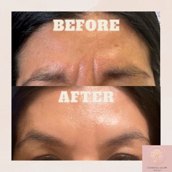 Eternal Glow Med Spa - Wrinkle treatment. Botox in frown lines. - Medical Spas Near Me Eternal Glow Med Spa - Wrinkle treatment. Botox in frown lines. - Medical Spas Near Me