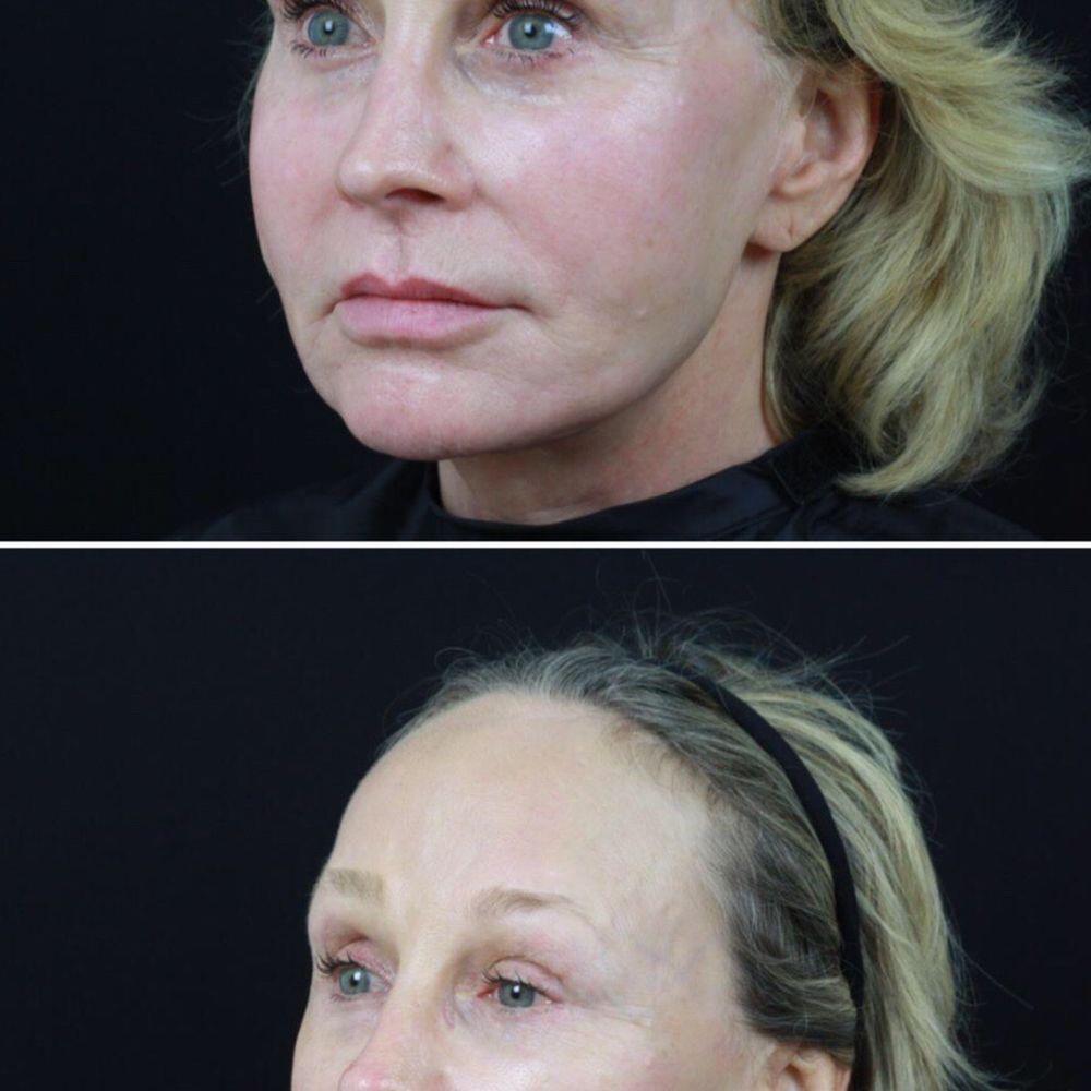 Rian A Maercks, MD - Before and after - Cosmetic Surgeons Near Me - Miami, Florida Rian A Maercks, MD - Before and after - Cosmetic Surgeons Near Me - Miami, Florida