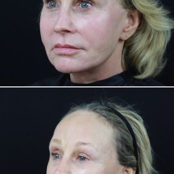 Rian A Maercks, MD - Before and after - Cosmetic Surgeons Near Me - Miami, Florida