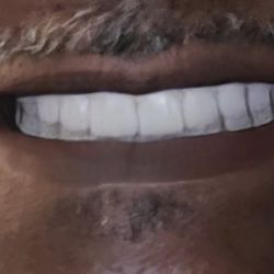 FastNewSmile