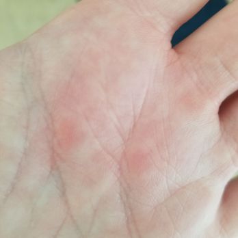 Life is labs Rescue, Inc - The burn marks on my hand after testing her collar - Animal Shelters Near Me - Temple, Georgia Life is labs Rescue, Inc - The burn marks on my hand after testing her collar - Animal Shelters Near Me - Temple, Georgia