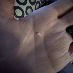 Southern Family Dental - Actual tooth that cracked and fell apart from the terrible filling