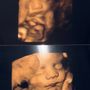 Photo of One Like Me - 3D/4D Ultrasound