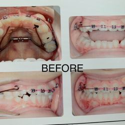 Chang Orthodontics - Left incisor was erupting in the gums because of overcrowding. This was another orthodontist's work, which Dr. Chang fixed.