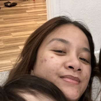 17 MedSpa - Before acne and hyperpigmentation treatments - Medical Spas Near Me - Buena Park, California