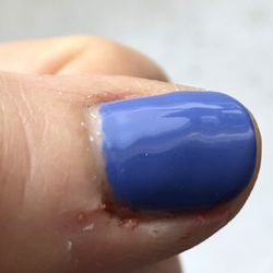 Chloe's Nail Spa - This is I got the bleeding to stop and I added my own antiseptic. The technician, who saw it while bleeding, said it was "fine."