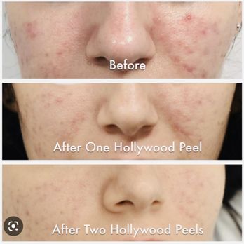 Erased Laser Tattoo Removal - Tattoo Removal Near Me - Las Vegas, Nevada Erased Laser Tattoo Removal - Tattoo Removal Near Me - Las Vegas, Nevada