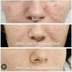 Erased Laser Tattoo Removal