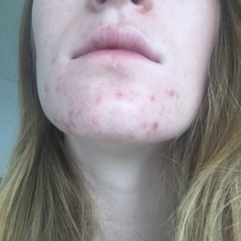 Face Five Acne Clinic - Before. - Skin Care Near Me - Colorado Springs, Colorado