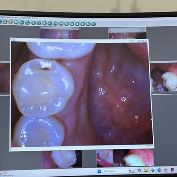 Conway Oaks Dental - The photo they showed me of the decay hidden in between those molars. - Cosmetic Dentists Near Me - Orlando, Florida