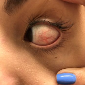 Elite Nails - Agitated eye , due to carelessness during a brow waxing session . - Nail Salons Near Me - Homestead, Florida