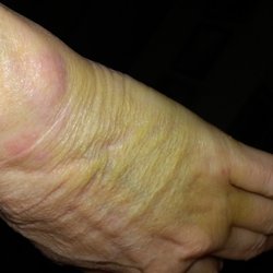 Kennesaw Family Medicine - Left hand - after swelling began to subside. Flexeril was all I was given!