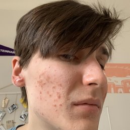 Burn spots on face