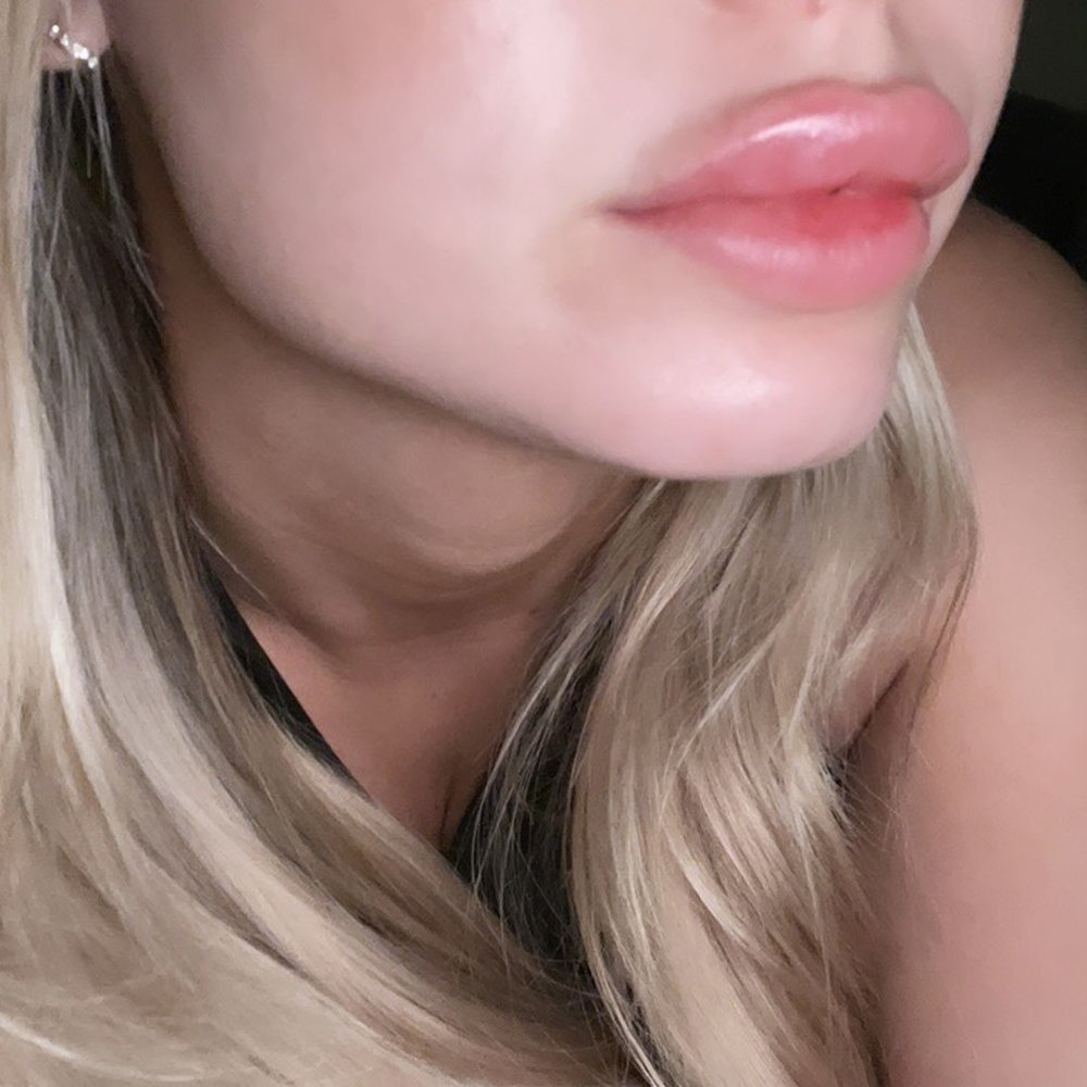 Transformative Wellness - After 1 syringe of Juvederm ultra XC. - IV Hydration Near Me - Vista, California Transformative Wellness - After 1 syringe of Juvederm ultra XC. - IV Hydration Near Me - Vista, California