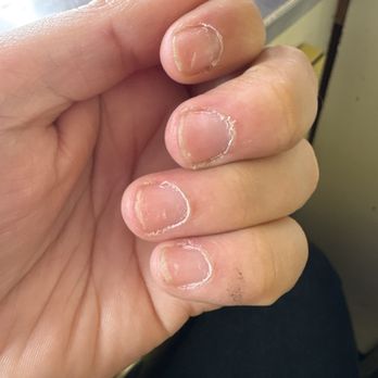 Eco Friendly Nail Salon - Nails before, just to show how bad they were! - Nail Salons Near Me - Sacramento, California