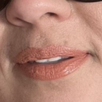 LaserAway - Before Lips - Laser Hair Removal Near Me - Valencia, California