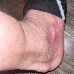 Franciscan Health Indianapolis - Current pic of ankle. Maybe if not rushed and properly treated could have been healed already