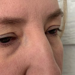 Piedmont Plastic Surgery & Dermatology - Folded skin over r. Eyelid