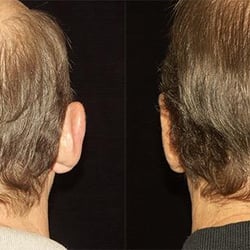 Blum Facial Surgery: Mitchell Blum, MD, FACS - Before and After Otoplasty Photos