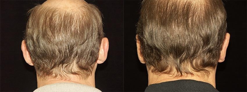 Blum Facial Surgery: Mitchell Blum, MD, FACS Logo
