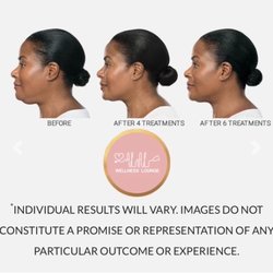 ALAL Wellness Lounge - Double chin no problem we can help with that