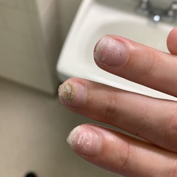 Crystal Nails & Spa - My lovely infection I'm trying to save you all from contracting - Nail Salons Near Me - Orland Park, Illinois Crystal Nails & Spa - My lovely infection I'm trying to save you all from contracting - Nail Salons Near Me - Orland Park, Illinois