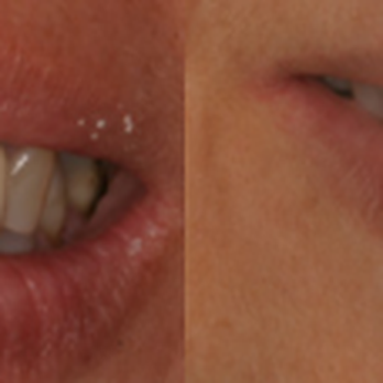 Montague Dental Excellence - Before/after - General Dentistry Near Me - Milpitas, California Montague Dental Excellence - Before/after - General Dentistry Near Me - Milpitas, California